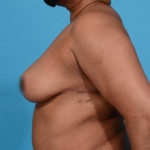 after breast reduction left side