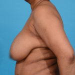 before breast reduction left side