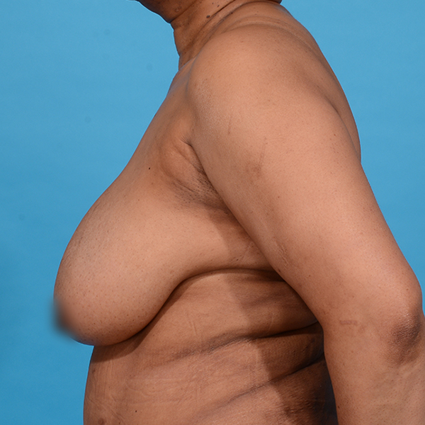 before breast reduction left side