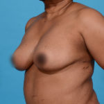 after breast reduction angle left side