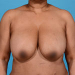 before breast reduction front