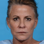 after eyelid lift front