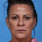 before eyelid lift front