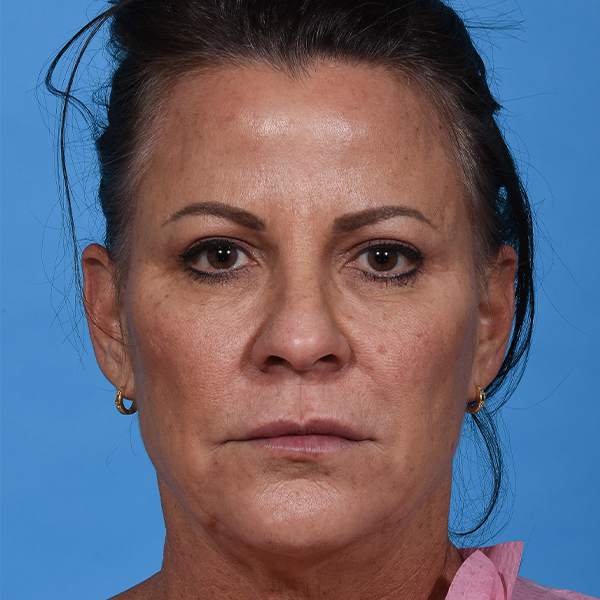before eyelid lift front