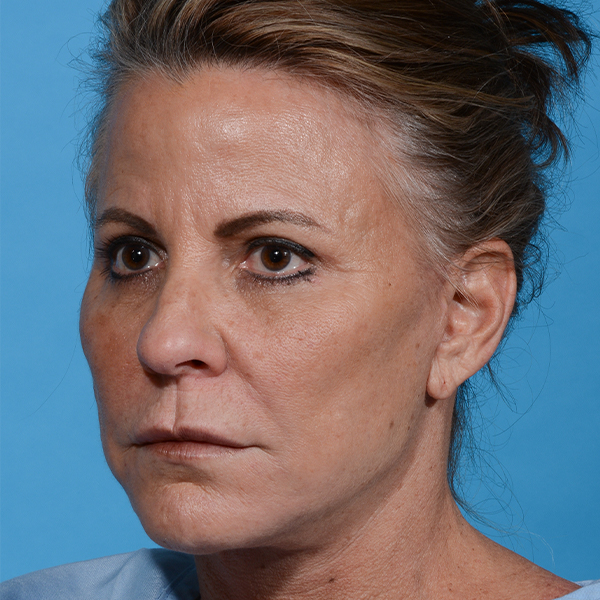after eyelid lift angle left