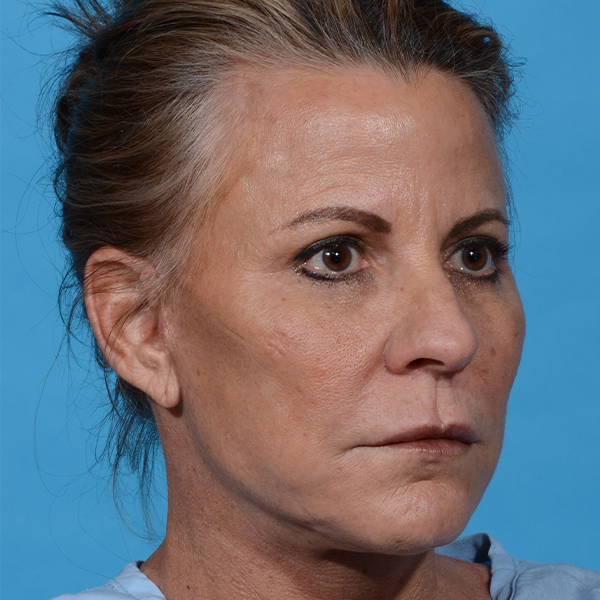 after eyelid lift angle right