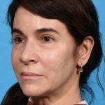 after eyelid lift angle left
