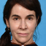 after eyelid lift front