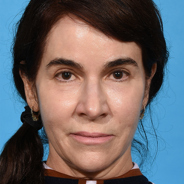 after eyelid lift front