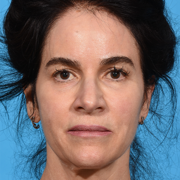 before eyelid lift front