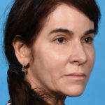 after eyelid lift angle right