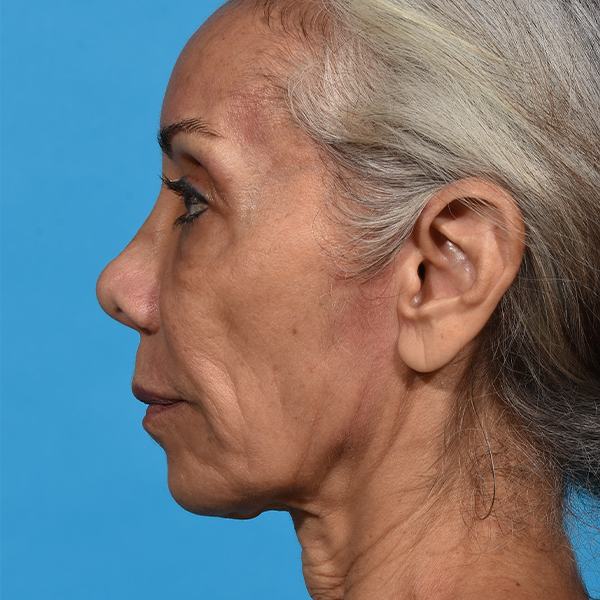 before facial fat grafting left