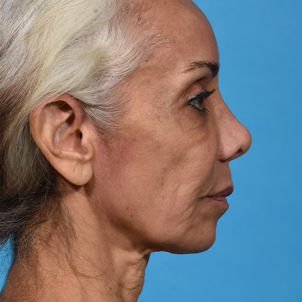 before facial fat grafting right