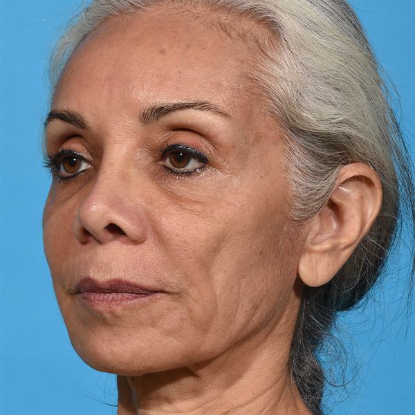 before facial fat grafting angle left