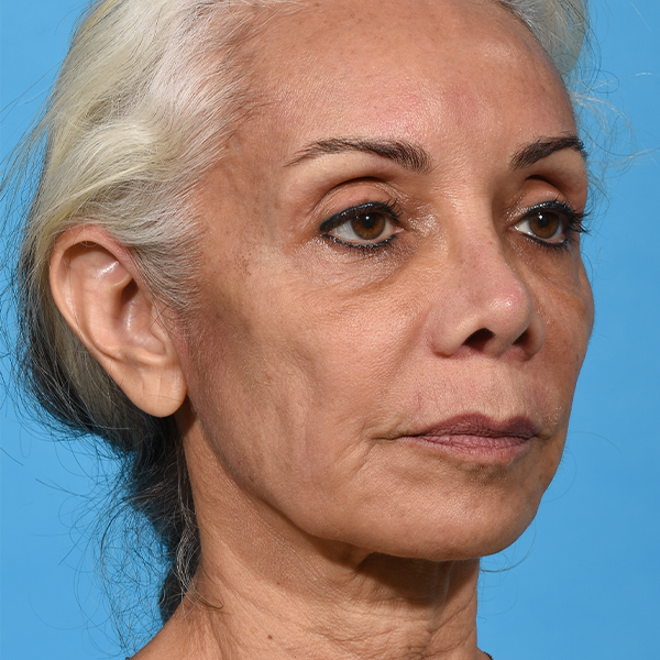 before facial fat grafting angle left