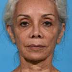before facial fat grafting front