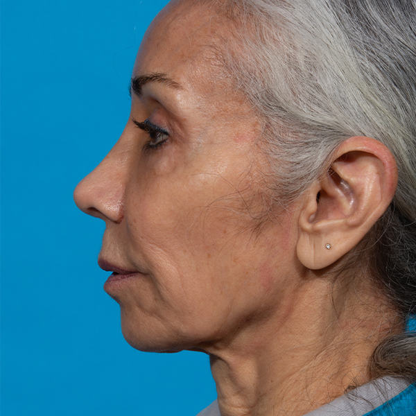 after facial fat grafting left