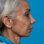 after facial fat grafting right