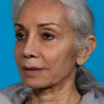 after facial fat grafting angle left