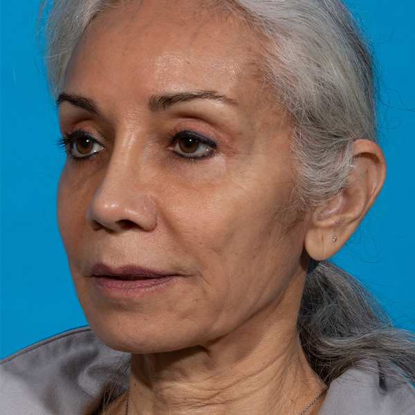 after facial fat grafting angle left