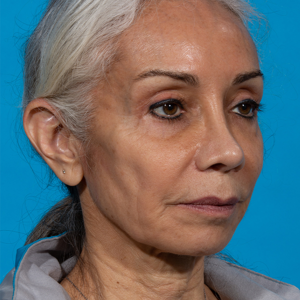 after facial fat grafting angle right