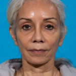 after facial fat grafting front