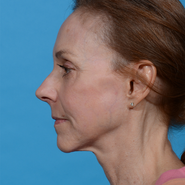 after laser resurfacing left