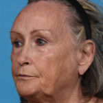before laser resurfacing angle left
