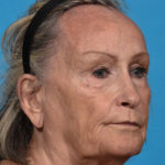 before laser resurfacing angle right