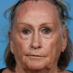 before laser resurfacing front