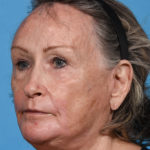after laser resurfacing angle left