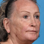 after laser resurfacing angle right