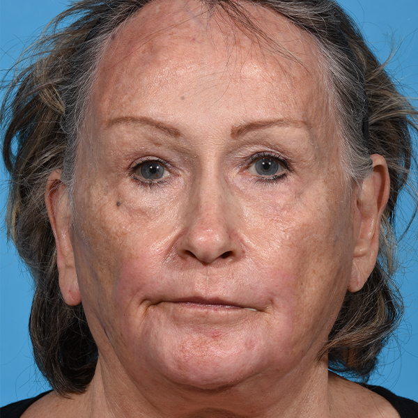 after laser resurfacing front