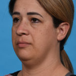 before neck liposuction angle left