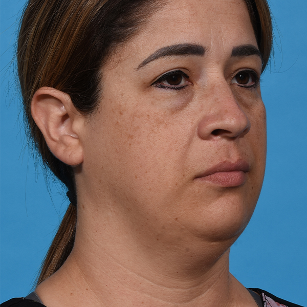before neck liposuction angle right