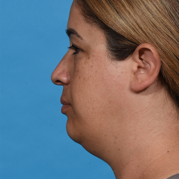 before neck liposuction left
