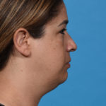 before neck liposuction right