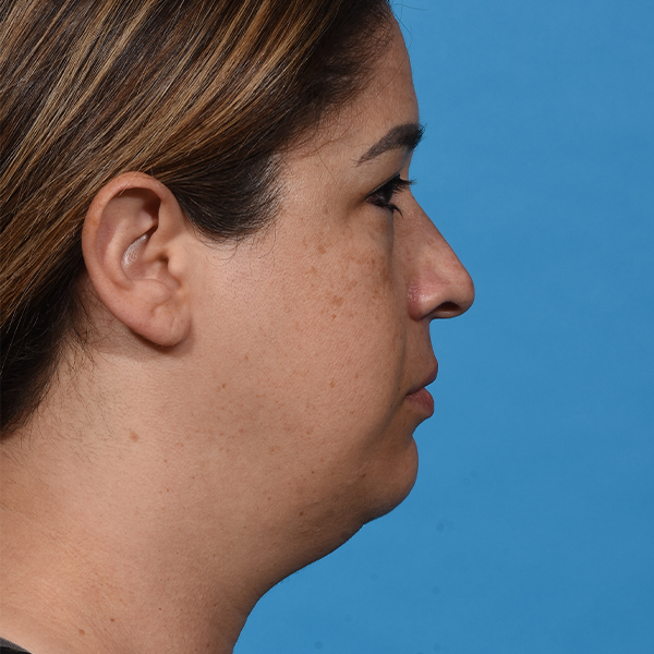 before neck liposuction right
