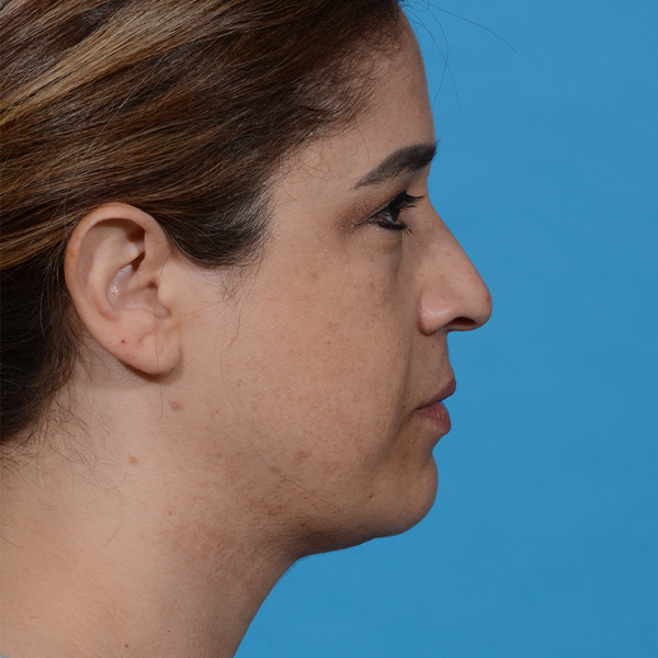 after neck liposuction right