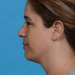 after neck liposuction left