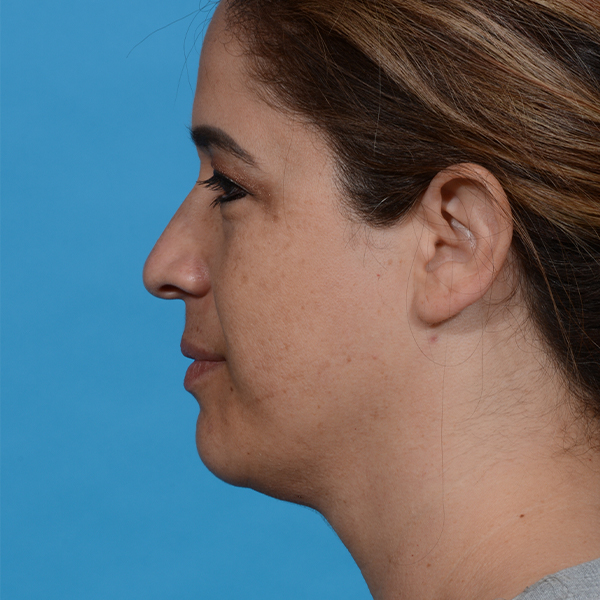 after neck liposuction left