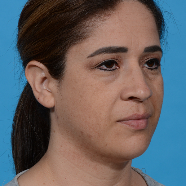 after neck liposuction angle right
