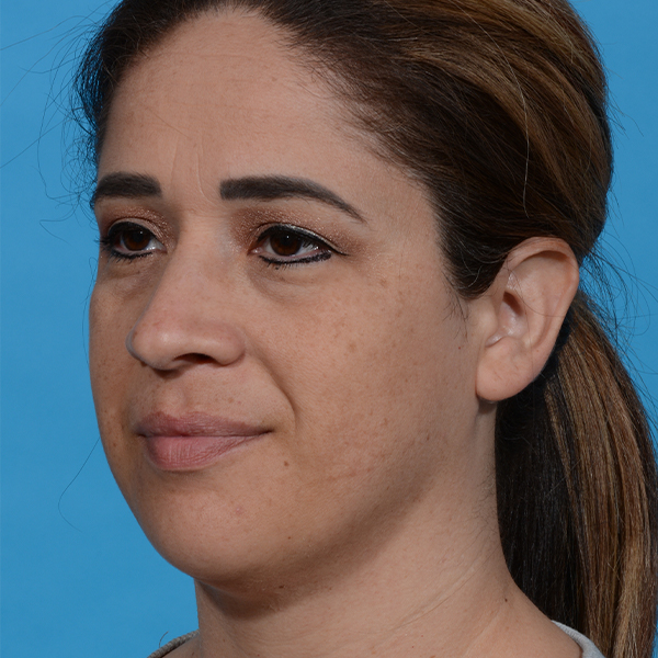 after neck liposuction angle left