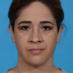 after neck liposuction front