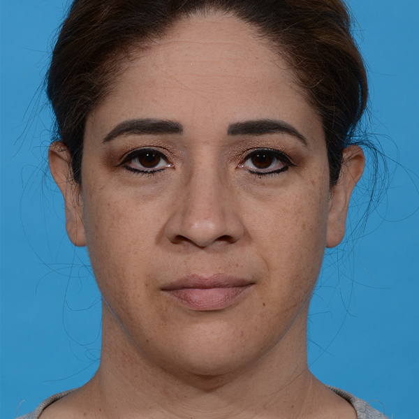 after neck liposuction front