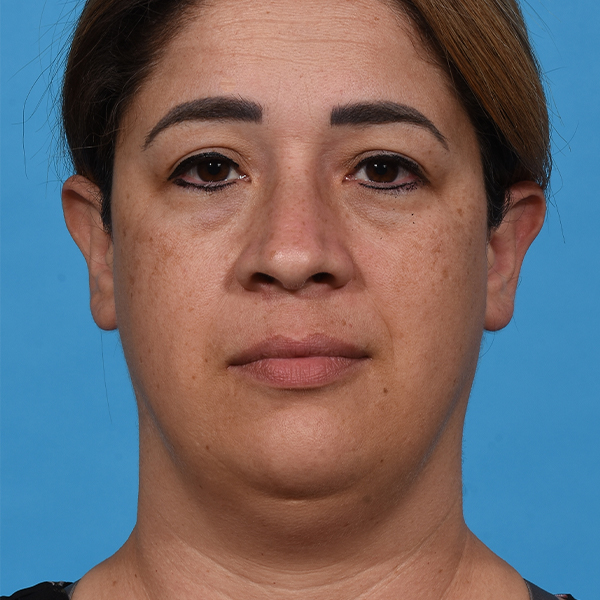 before neck liposuction front