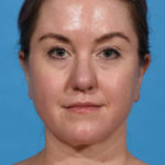 after neck liposuction front
