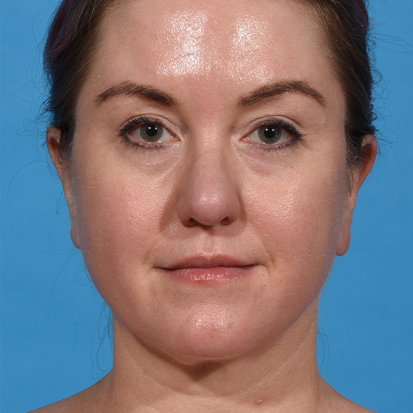 after neck liposuction front