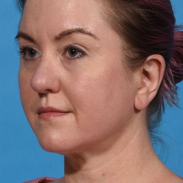 after neck liposuction angle left
