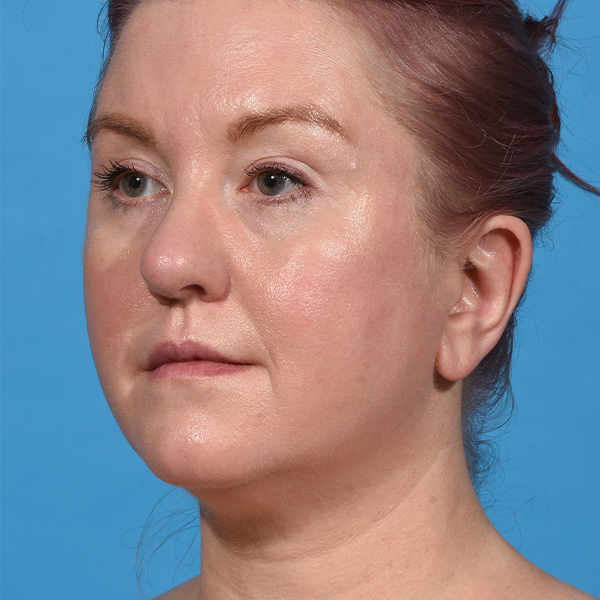 before neck liposuction angle left